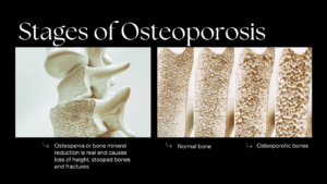 Stages of Osteoporosis