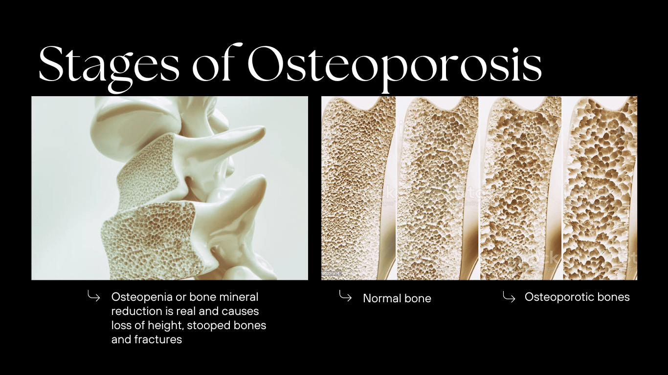 Osteoporosis Check Save bone before it’s too late